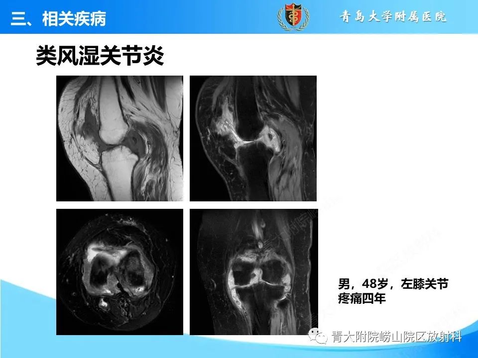 影像PPT - 【PPT】膝关节周围滑囊及其相关疾病的 MRI 表现-27