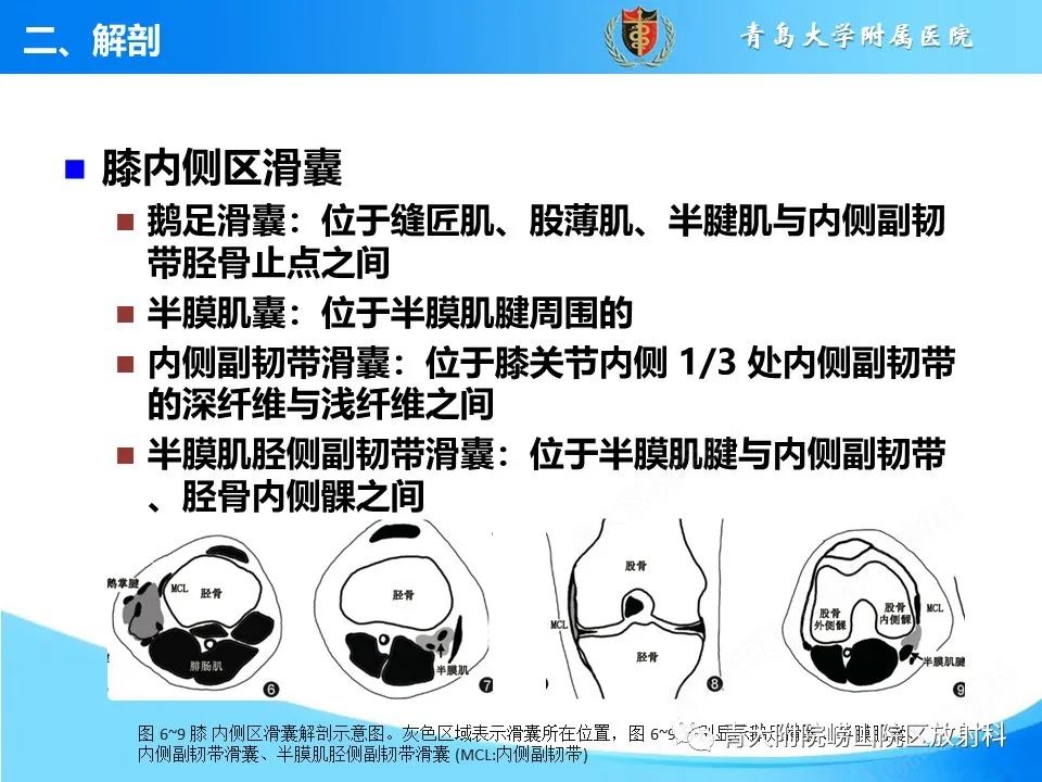 影像PPT - 【PPT】膝关节周围滑囊及其相关疾病的 MRI 表现-9