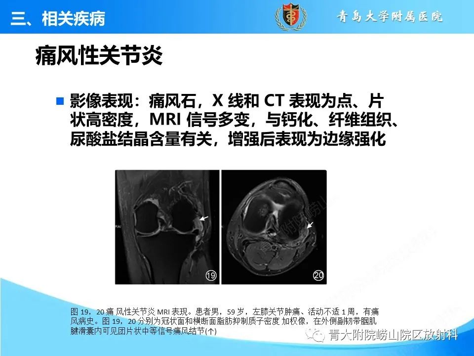 影像PPT - 【PPT】膝关节周围滑囊及其相关疾病的 MRI 表现-24