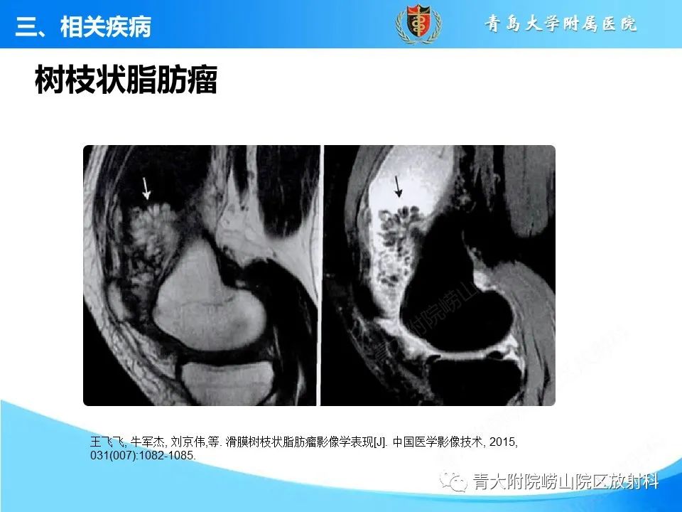 影像PPT - 【PPT】膝关节周围滑囊及其相关疾病的 MRI 表现-42