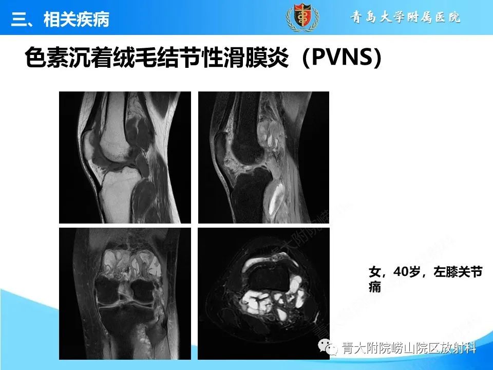 影像PPT - 【PPT】膝关节周围滑囊及其相关疾病的 MRI 表现-37