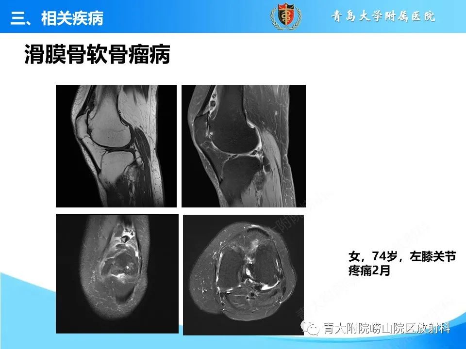 影像PPT - 【PPT】膝关节周围滑囊及其相关疾病的 MRI 表现-39