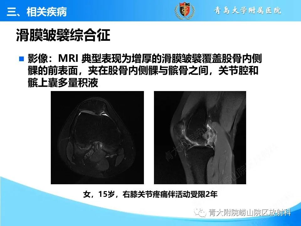 影像PPT - 【PPT】膝关节周围滑囊及其相关疾病的 MRI 表现-44