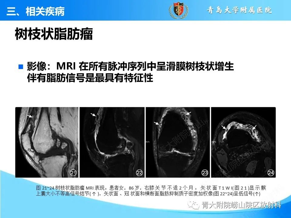 影像PPT - 【PPT】膝关节周围滑囊及其相关疾病的 MRI 表现-41