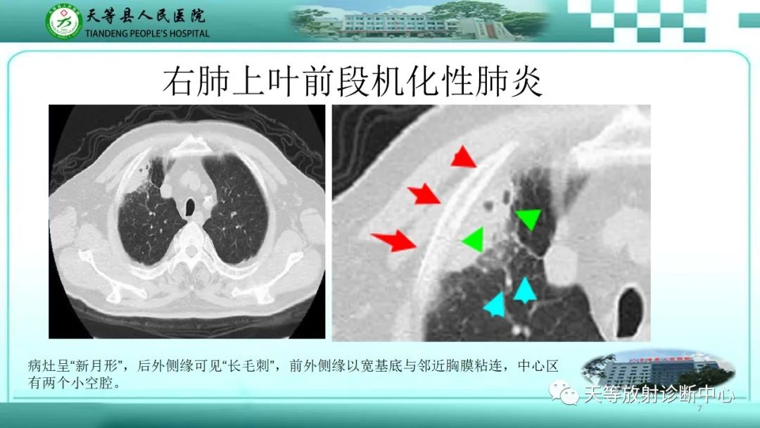 影像PPT - 【PPT】局灶性机化性肺炎的临床与CT诊断-7 影像PPT - 【PPT】局灶性机化性肺炎的临床与CT诊断-7