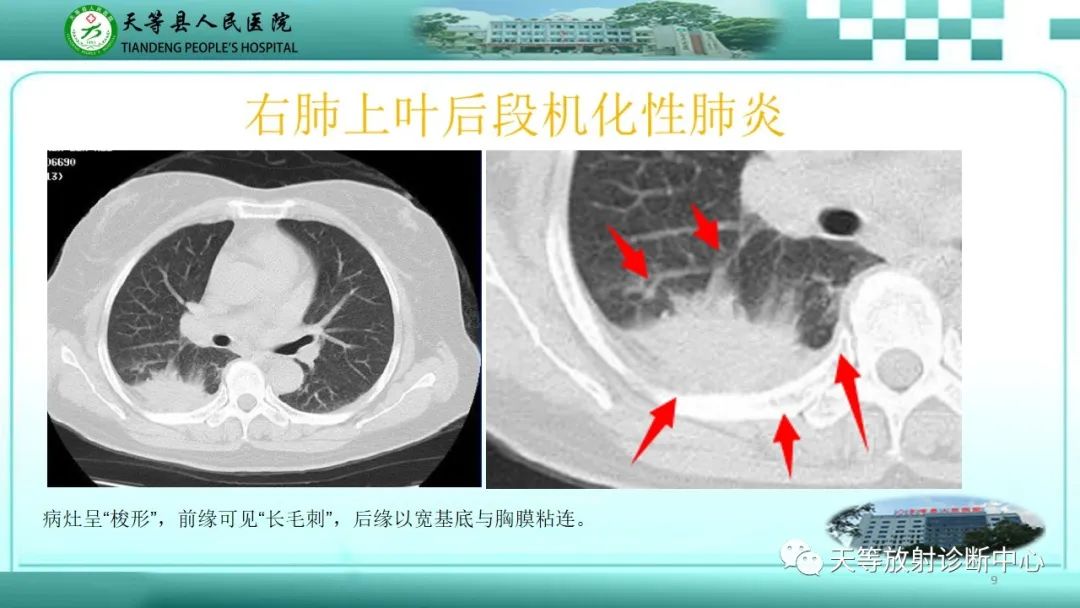 影像PPT - 【PPT】局灶性机化性肺炎的临床与CT诊断-9 影像PPT - 【PPT】局灶性机化性肺炎的临床与CT诊断-9