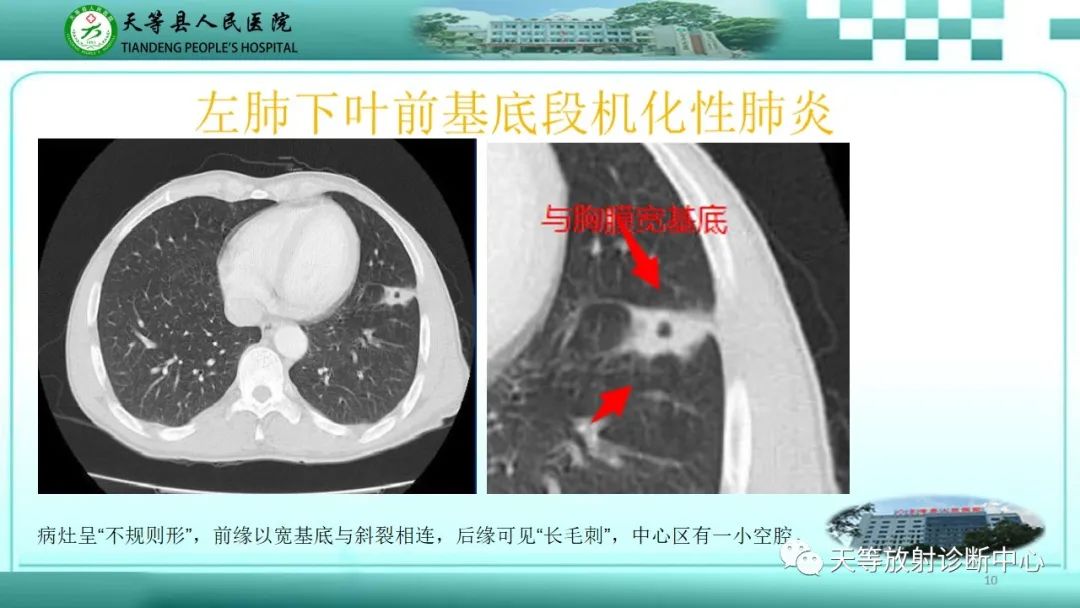 影像PPT - 【PPT】局灶性机化性肺炎的临床与CT诊断-10 影像PPT - 【PPT】局灶性机化性肺炎的临床与CT诊断-10