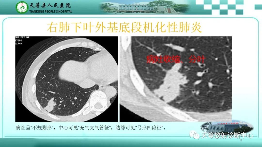 影像PPT - 【PPT】局灶性机化性肺炎的临床与CT诊断-8 影像PPT - 【PPT】局灶性机化性肺炎的临床与CT诊断-8
