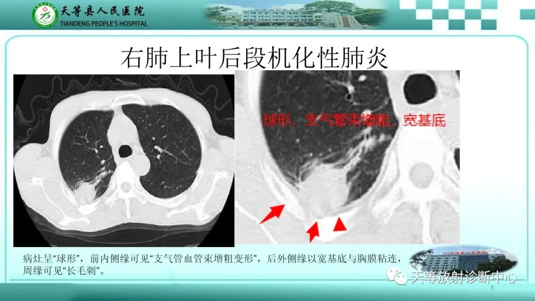 影像PPT - 【PPT】局灶性机化性肺炎的临床与CT诊断-6 影像PPT - 【PPT】局灶性机化性肺炎的临床与CT诊断-6