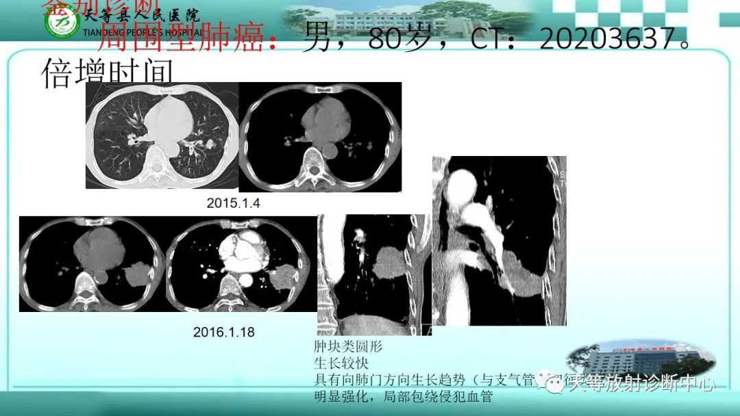 影像PPT - 【PPT】局灶性机化性肺炎的临床与CT诊断-18 影像PPT - 【PPT】局灶性机化性肺炎的临床与CT诊断-18