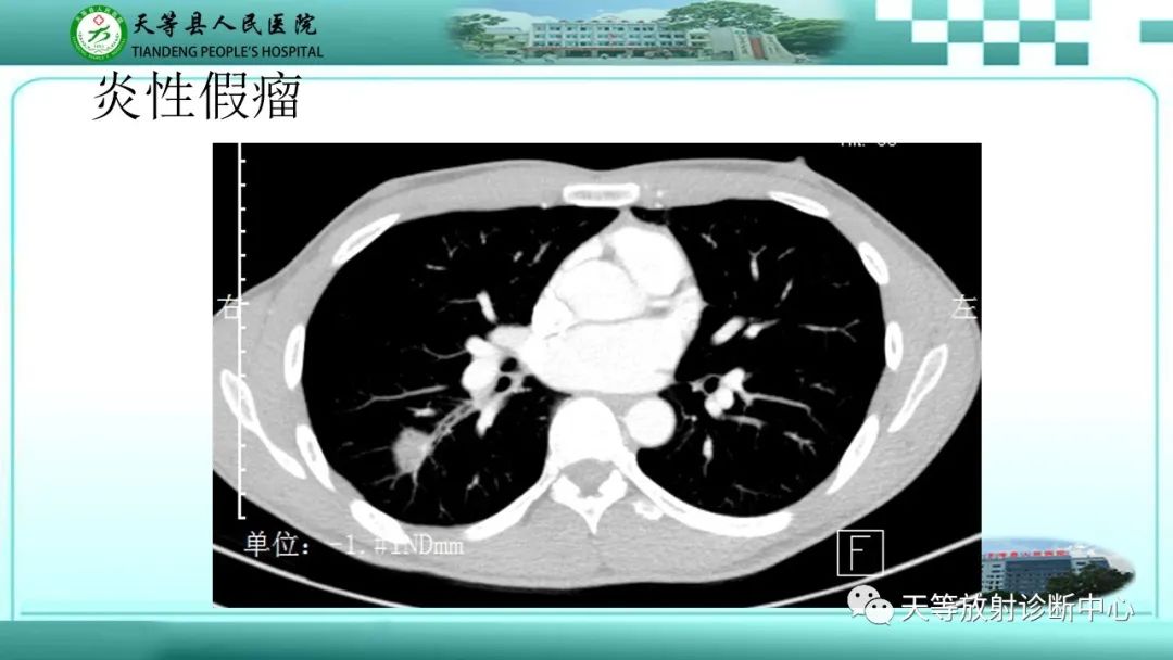 影像PPT - 【PPT】局灶性机化性肺炎的临床与CT诊断-27 影像PPT - 【PPT】局灶性机化性肺炎的临床与CT诊断-27