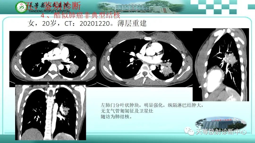 影像PPT - 【PPT】局灶性机化性肺炎的临床与CT诊断-24 影像PPT - 【PPT】局灶性机化性肺炎的临床与CT诊断-24