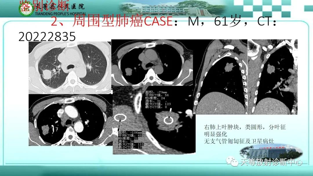 影像PPT - 【PPT】局灶性机化性肺炎的临床与CT诊断-20 影像PPT - 【PPT】局灶性机化性肺炎的临床与CT诊断-20