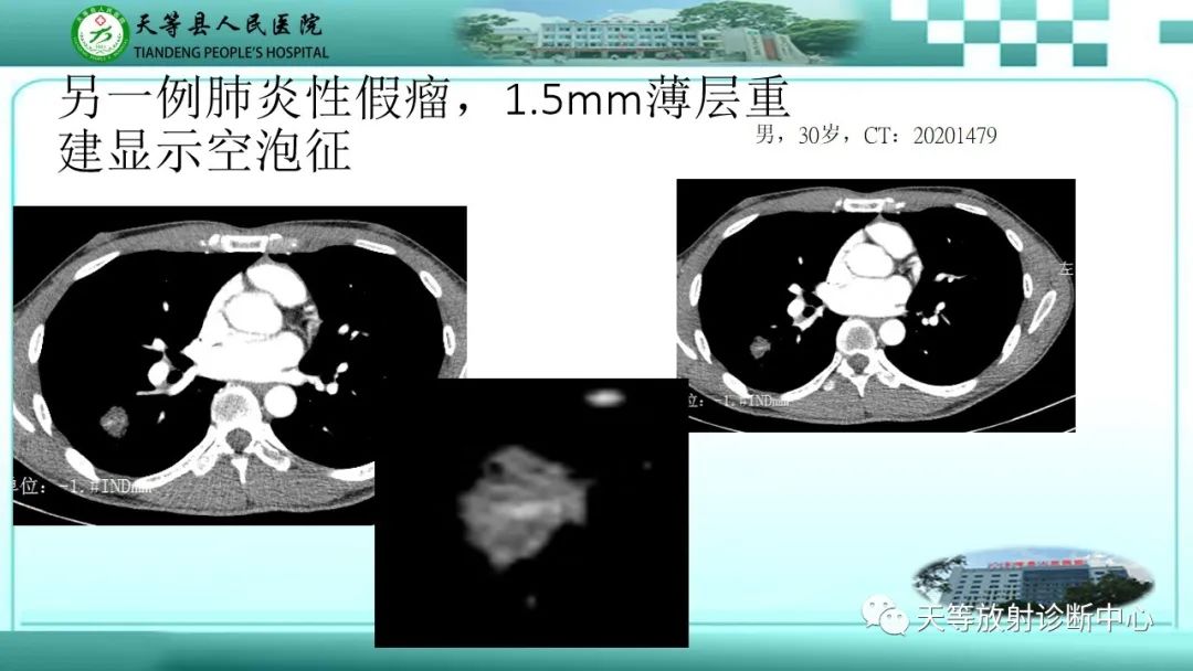 影像PPT - 【PPT】局灶性机化性肺炎的临床与CT诊断-26 影像PPT - 【PPT】局灶性机化性肺炎的临床与CT诊断-26