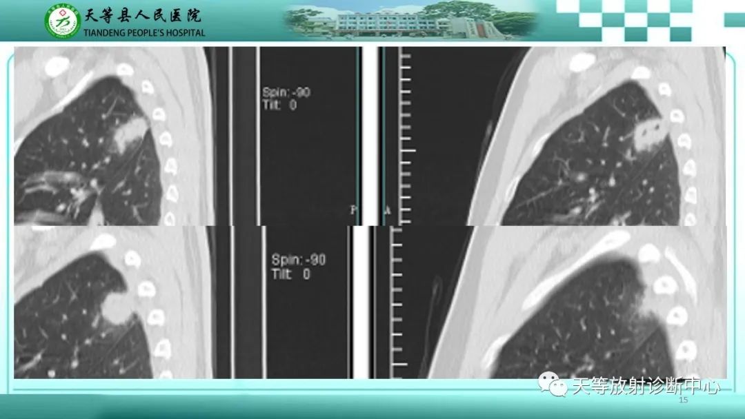 影像PPT - 【PPT】局灶性机化性肺炎的临床与CT诊断-15 影像PPT - 【PPT】局灶性机化性肺炎的临床与CT诊断-15