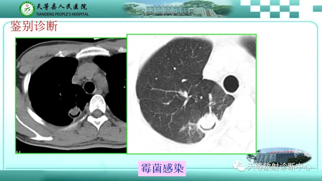 影像PPT - 【PPT】局灶性机化性肺炎的临床与CT诊断-29 影像PPT - 【PPT】局灶性机化性肺炎的临床与CT诊断-29