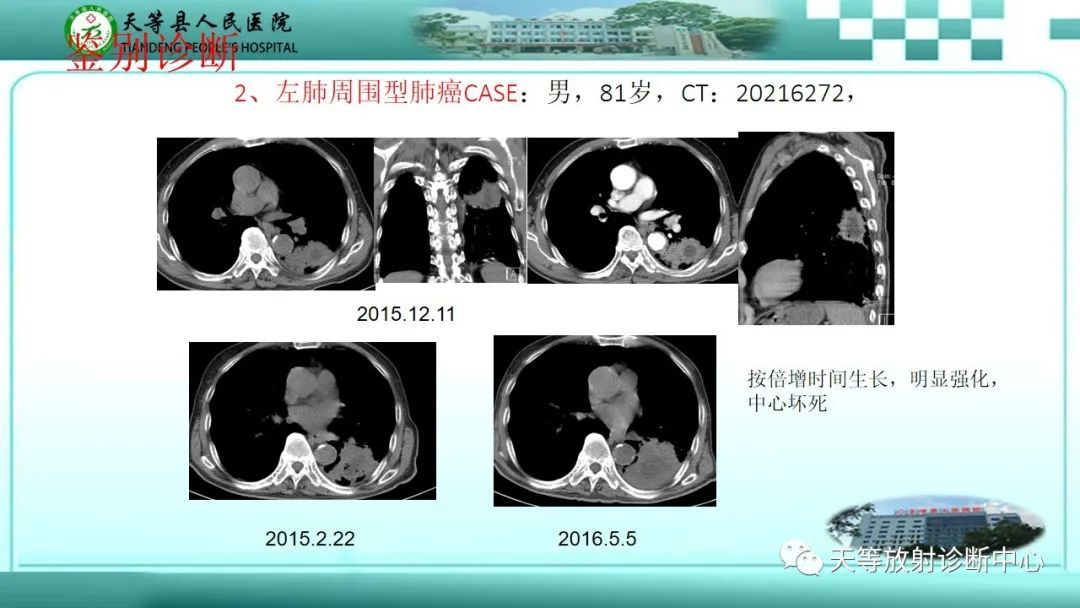 影像PPT - 【PPT】局灶性机化性肺炎的临床与CT诊断-19 影像PPT - 【PPT】局灶性机化性肺炎的临床与CT诊断-19