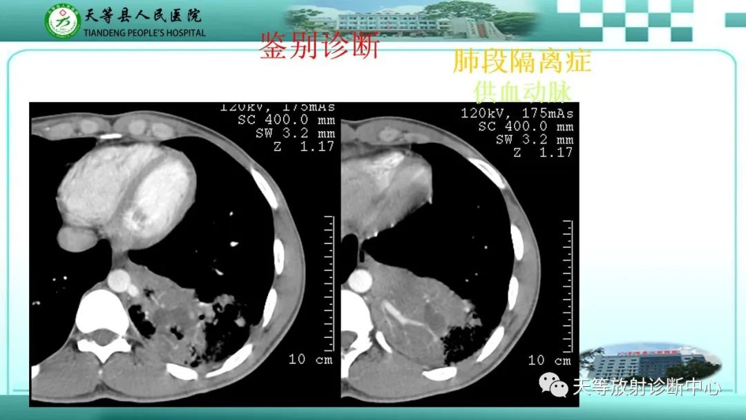 影像PPT - 【PPT】局灶性机化性肺炎的临床与CT诊断-31 影像PPT - 【PPT】局灶性机化性肺炎的临床与CT诊断-31