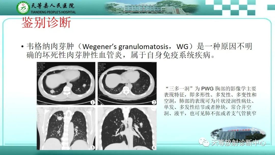 影像PPT - 【PPT】局灶性机化性肺炎的临床与CT诊断-28 影像PPT - 【PPT】局灶性机化性肺炎的临床与CT诊断-28