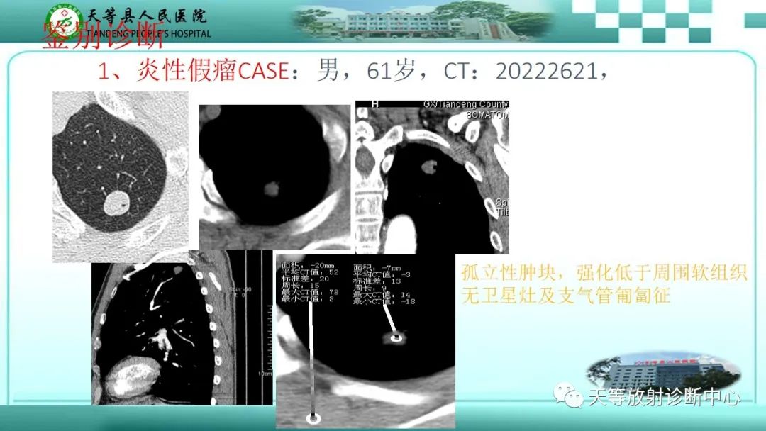 影像PPT - 【PPT】局灶性机化性肺炎的临床与CT诊断-25 影像PPT - 【PPT】局灶性机化性肺炎的临床与CT诊断-25