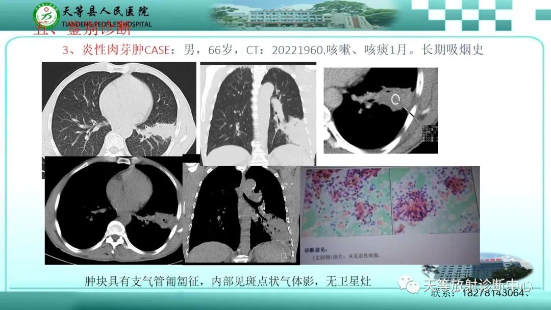 影像PPT - 【PPT】局灶性机化性肺炎的临床与CT诊断-23 影像PPT - 【PPT】局灶性机化性肺炎的临床与CT诊断-23