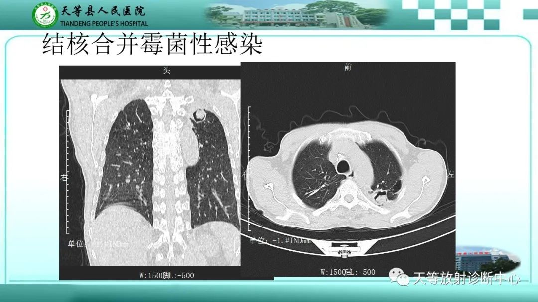 影像PPT - 【PPT】局灶性机化性肺炎的临床与CT诊断-30 影像PPT - 【PPT】局灶性机化性肺炎的临床与CT诊断-30