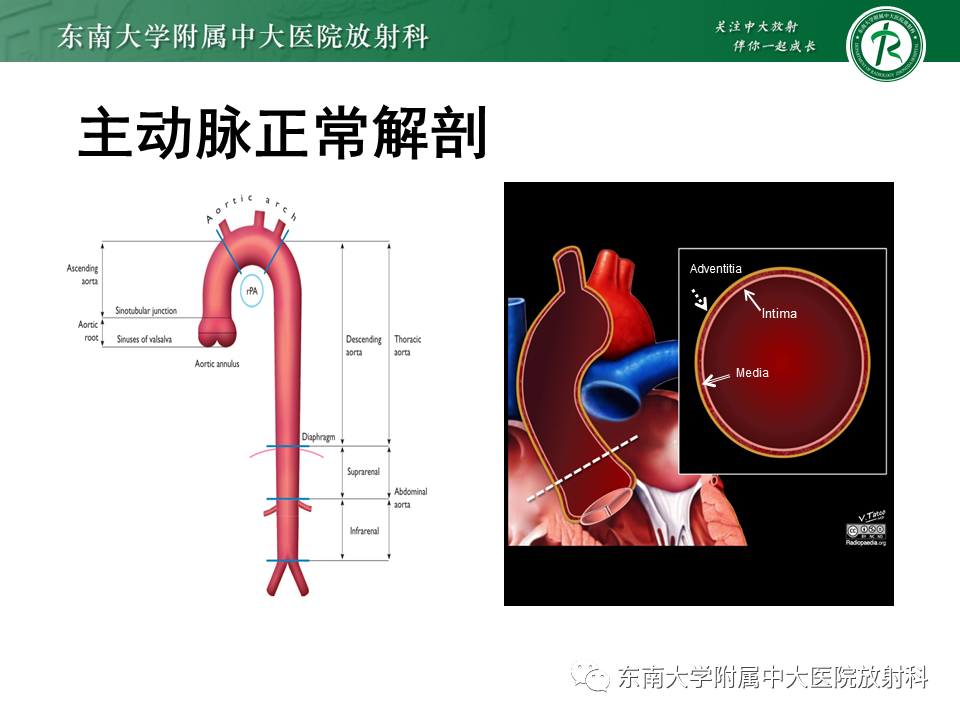 影像PPT - 【PPT】急性主动脉夹层-5