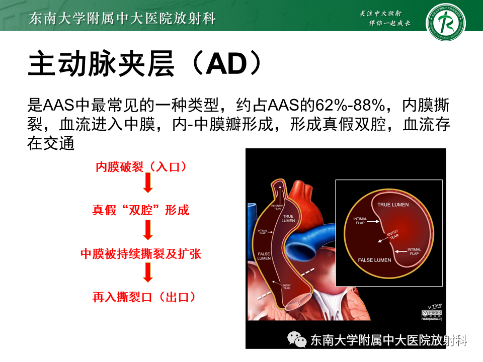 影像PPT - 【PPT】急性主动脉夹层-7