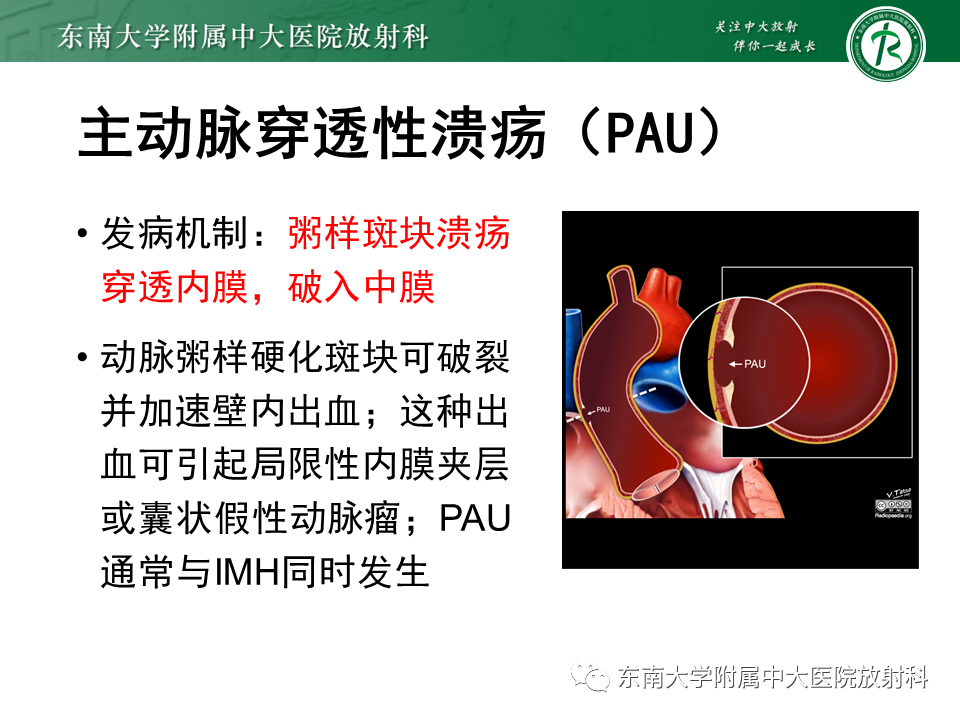 影像PPT - 【PPT】急性主动脉夹层-18