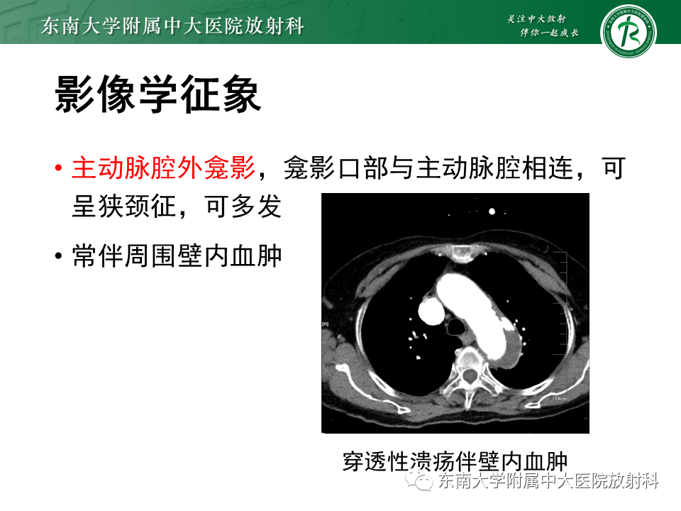 影像PPT - 【PPT】急性主动脉夹层-19