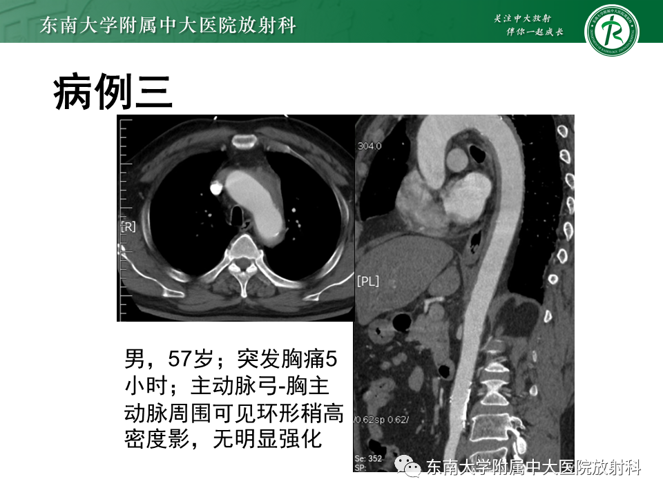 影像PPT - 【PPT】急性主动脉夹层-16