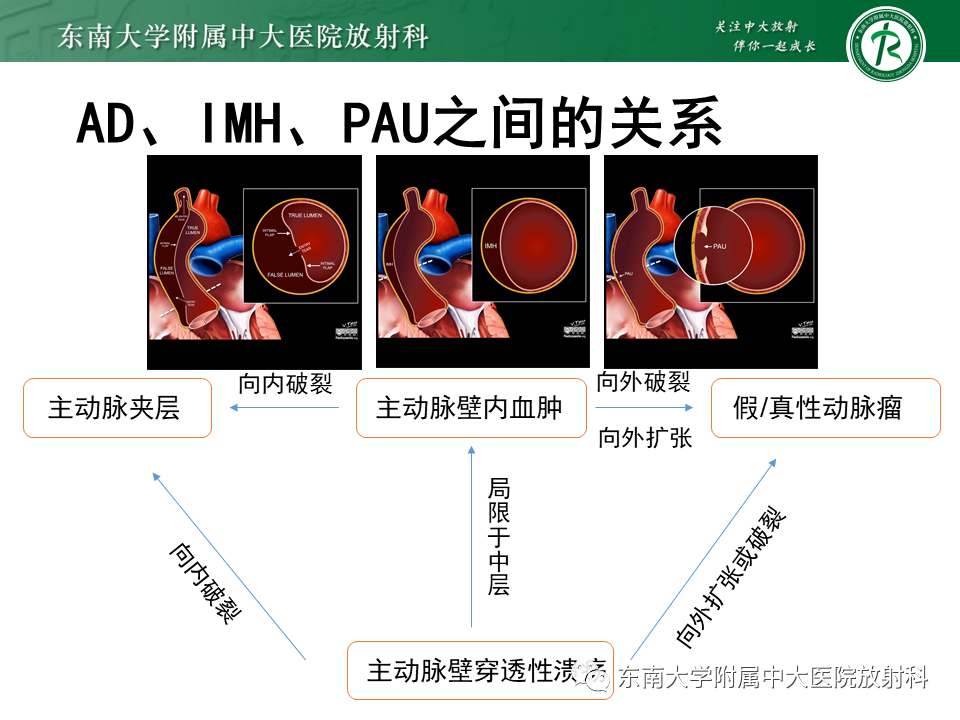 影像PPT - 【PPT】急性主动脉夹层-22