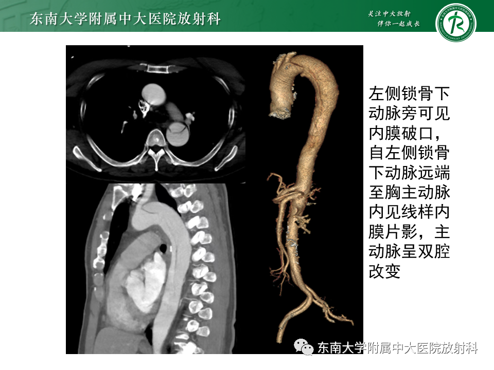 影像PPT - 【PPT】急性主动脉夹层-2
