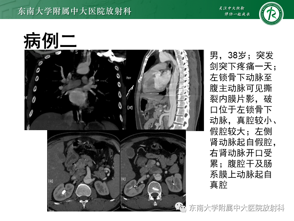 影像PPT - 【PPT】急性主动脉夹层-12