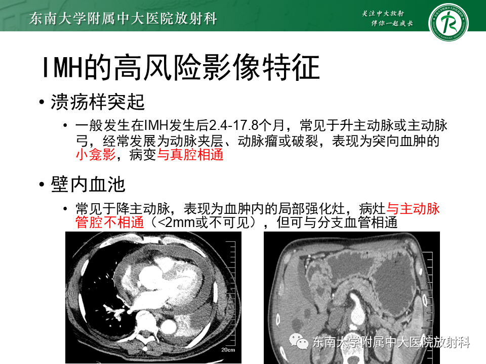 影像PPT - 【PPT】急性主动脉夹层-17