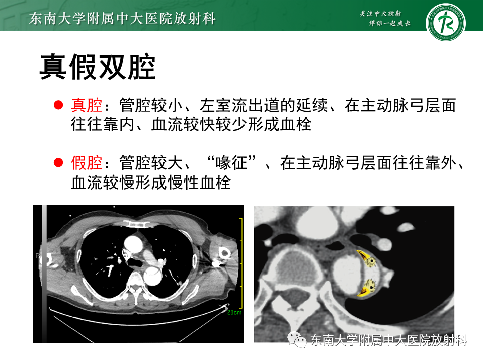 影像PPT - 【PPT】急性主动脉夹层-11