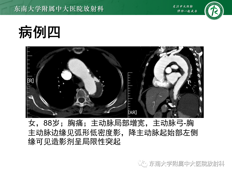 影像PPT - 【PPT】急性主动脉夹层-20