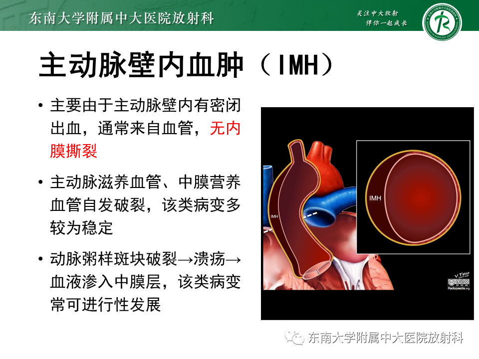 影像PPT - 【PPT】急性主动脉夹层-14