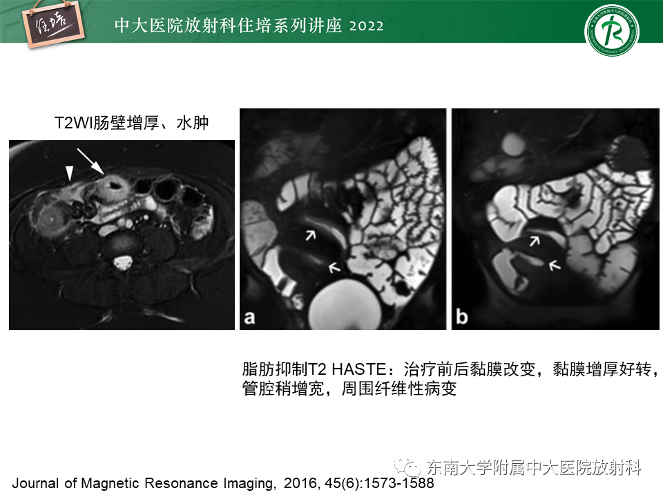 影像PPT - 【PPT】从临床关注点出发——克罗恩病影像再认识-12