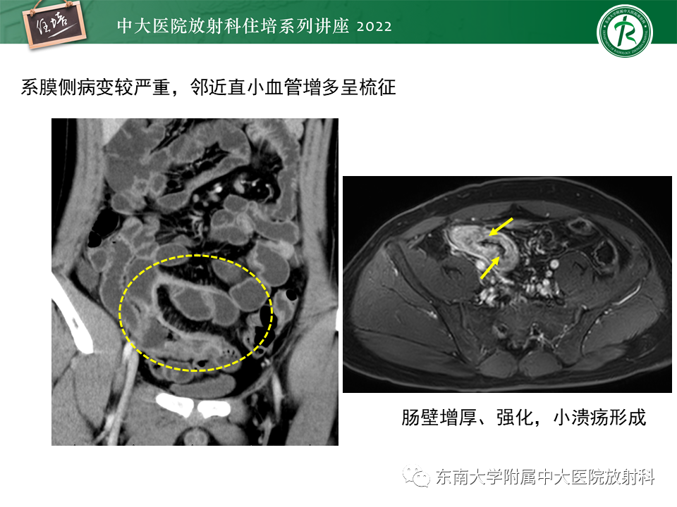 影像PPT - 【PPT】从临床关注点出发——克罗恩病影像再认识-13