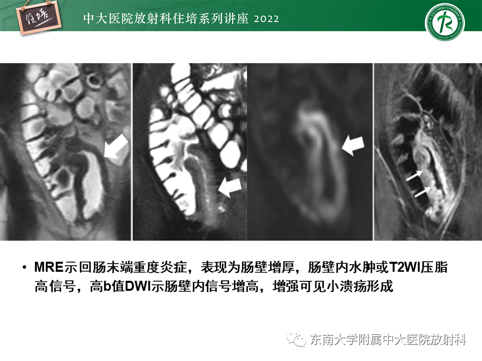 影像PPT - 【PPT】从临床关注点出发——克罗恩病影像再认识-14