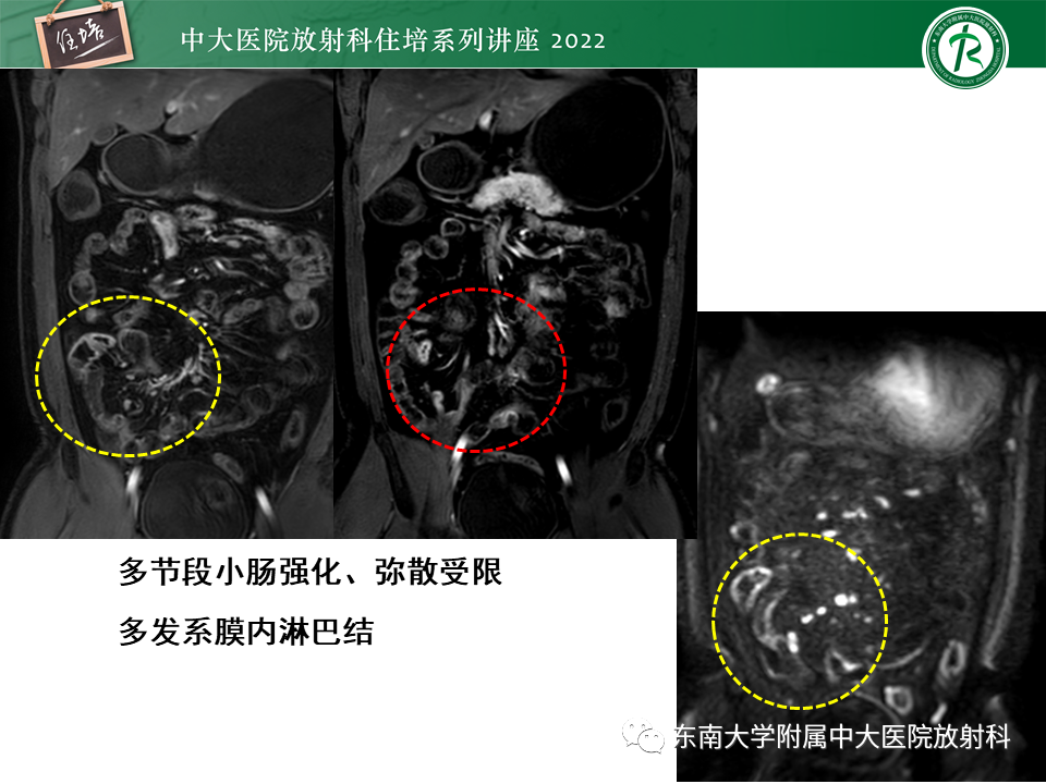 影像PPT - 【PPT】从临床关注点出发——克罗恩病影像再认识-19