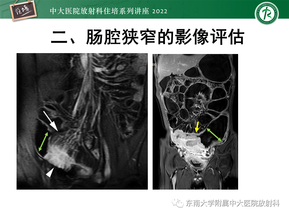 影像PPT - 【PPT】从临床关注点出发——克罗恩病影像再认识-24