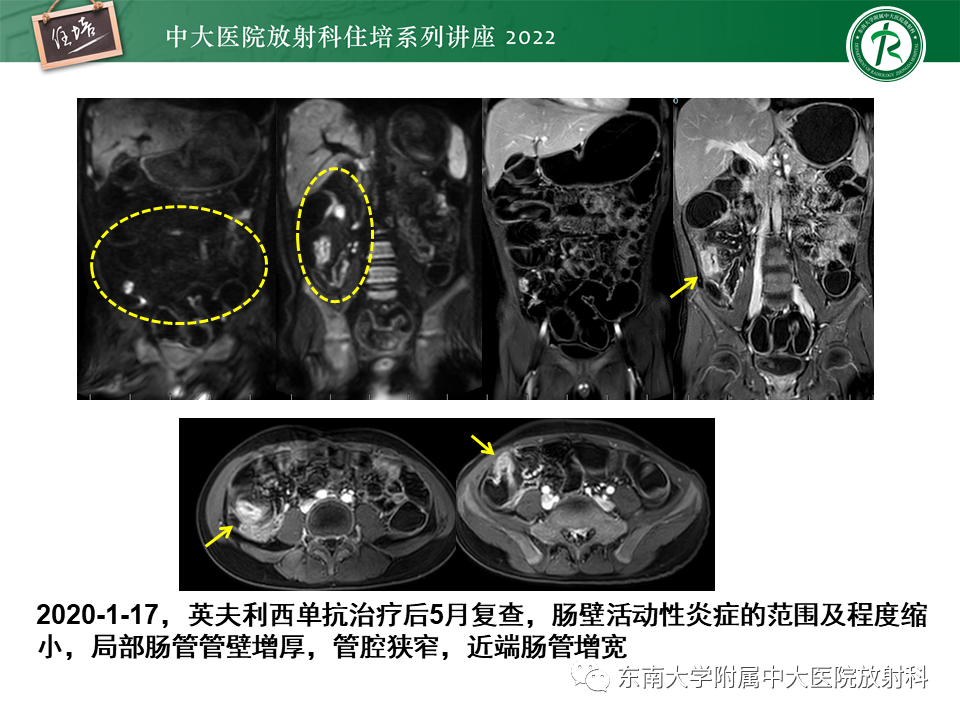 影像PPT - 【PPT】从临床关注点出发——克罗恩病影像再认识-27
