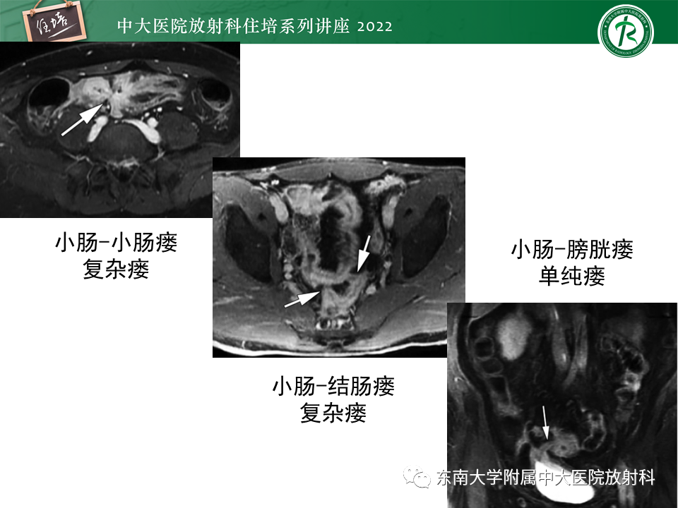 影像PPT - 【PPT】从临床关注点出发——克罗恩病影像再认识-32