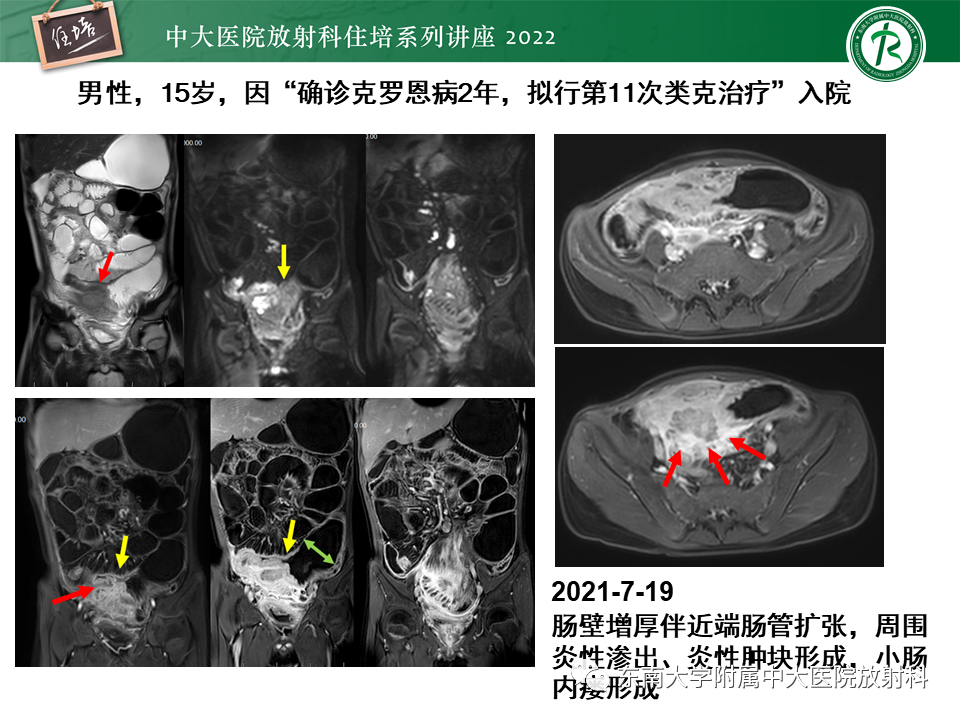 影像PPT - 【PPT】从临床关注点出发——克罗恩病影像再认识-34