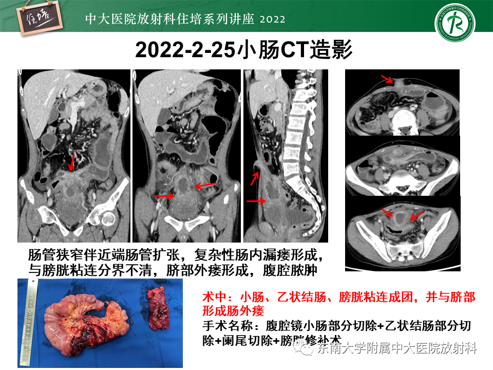 影像PPT - 【PPT】从临床关注点出发——克罗恩病影像再认识-36