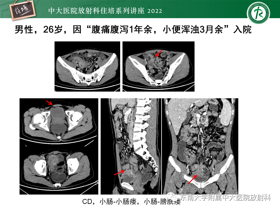 影像PPT - 【PPT】从临床关注点出发——克罗恩病影像再认识-37