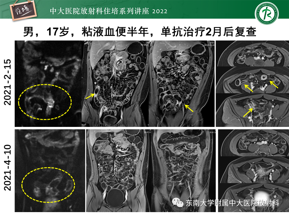 影像PPT - 【PPT】从临床关注点出发——克罗恩病影像再认识-40