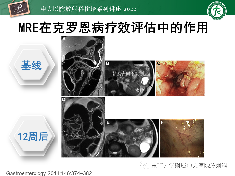 影像PPT - 【PPT】从临床关注点出发——克罗恩病影像再认识-43